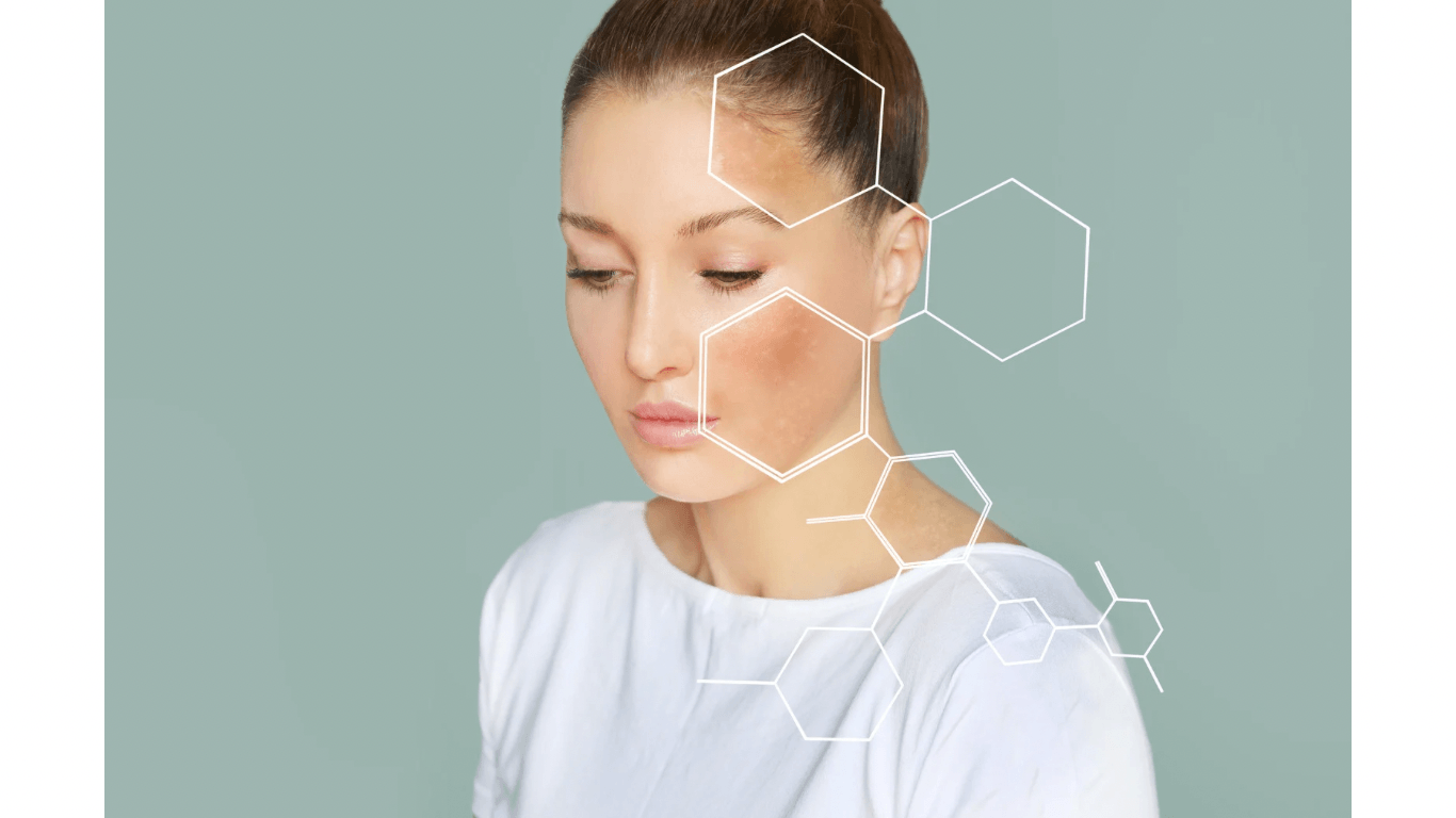 Pigmentstörungen – Altersflecken und Melasma